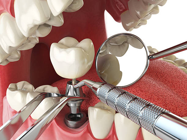 Best Emergency Gum Treatment in Ladue, MO
